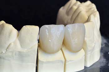 Easton Dental Crowns