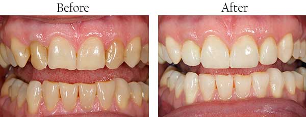 Palmer Before and After ClearCorrect