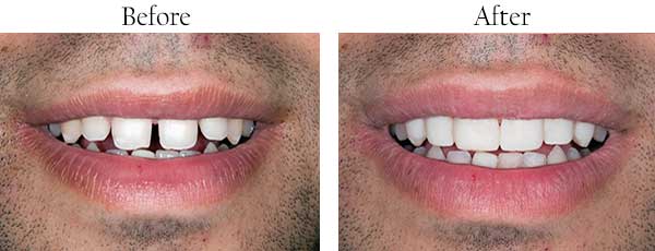 Bethlehem Before and After Dental Crowns